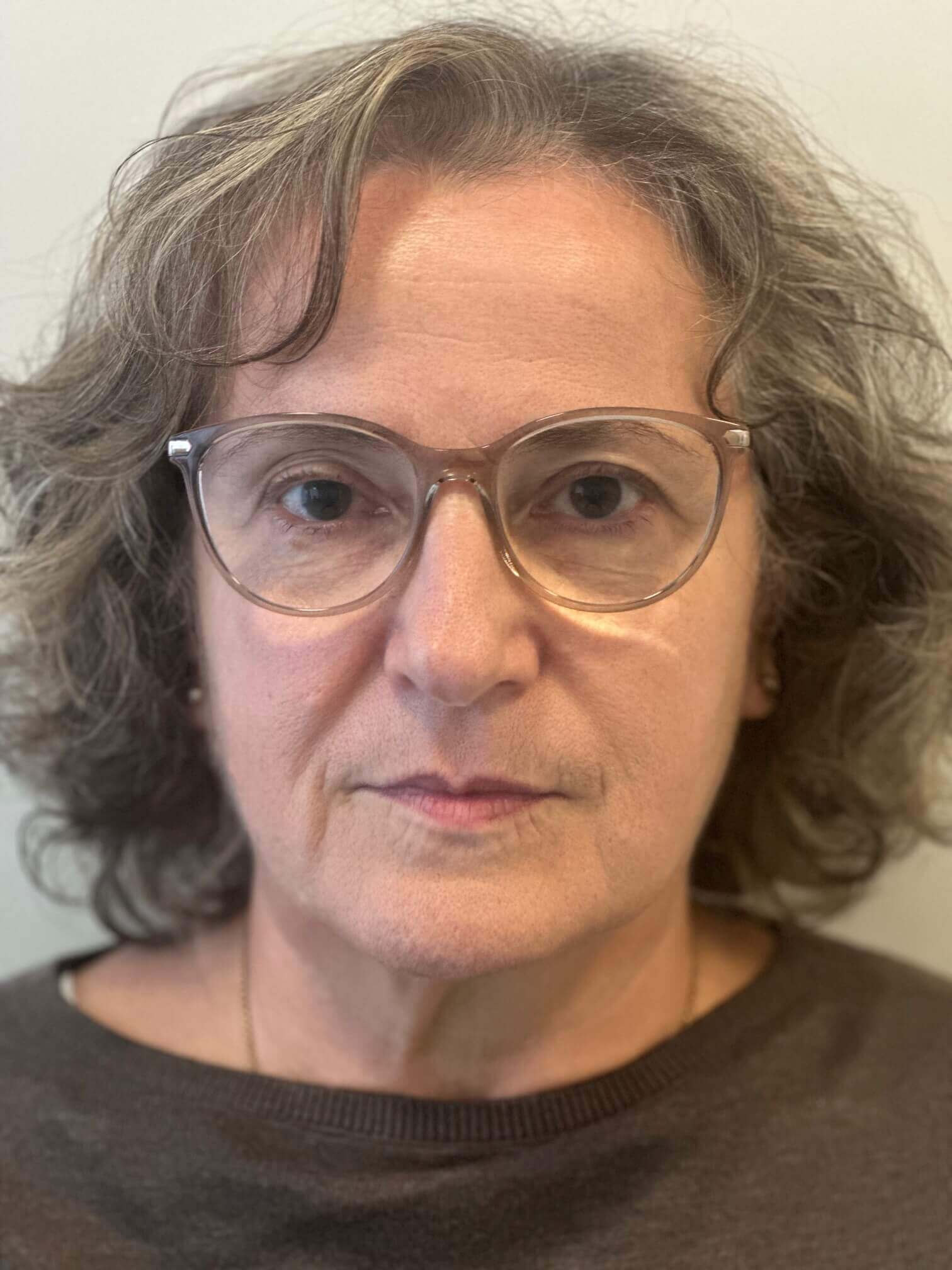 prima supracor femtolasik correzione ipermetropia presbiopia media elevata dr. angelo appiotti