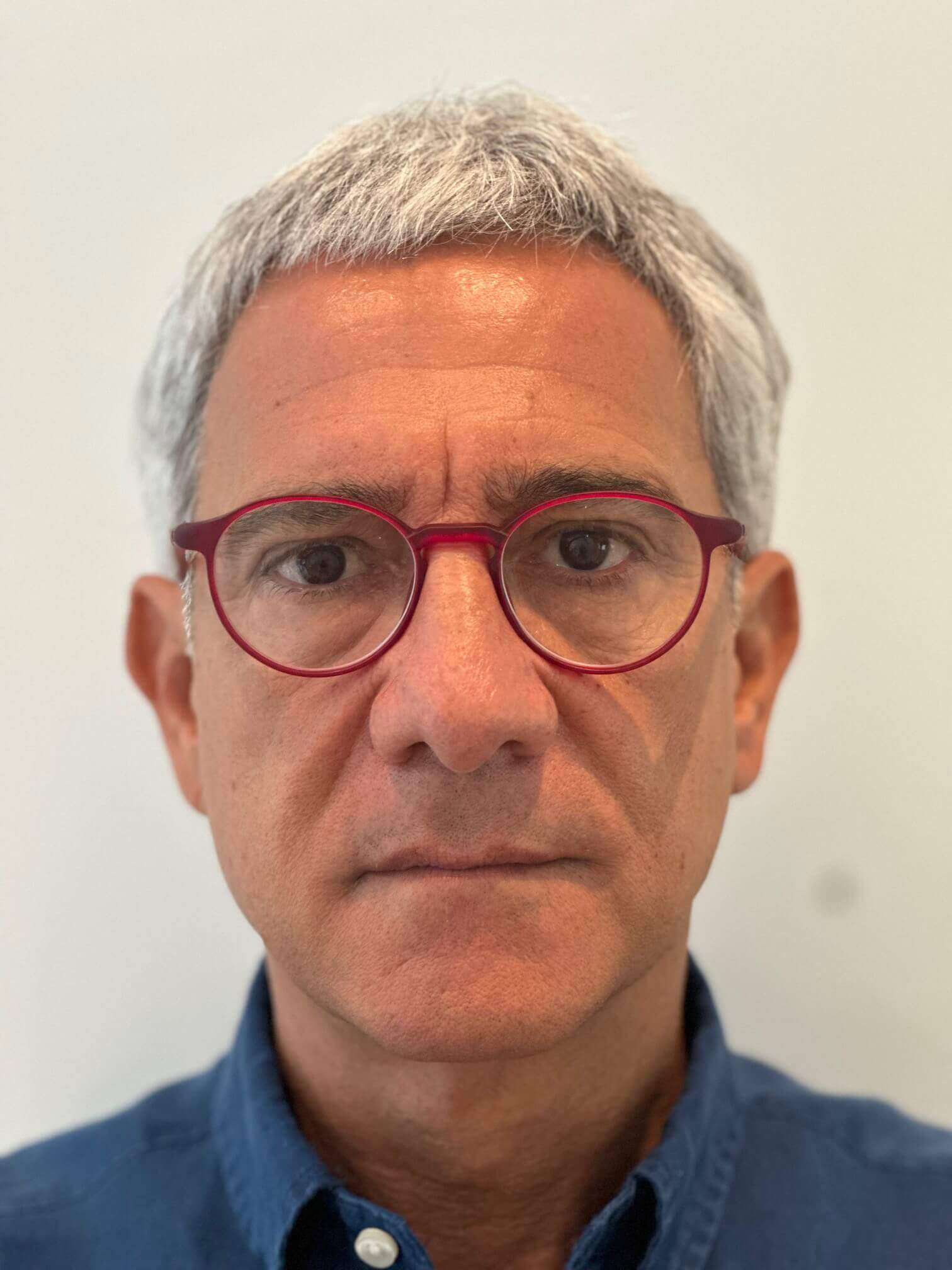 prima supracor femtolasik correzione miopia astigmatismo presbiopia dr. angelo appiotti