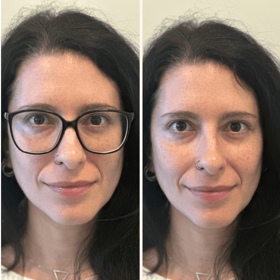 intervento miopia ed medi prima e dopo