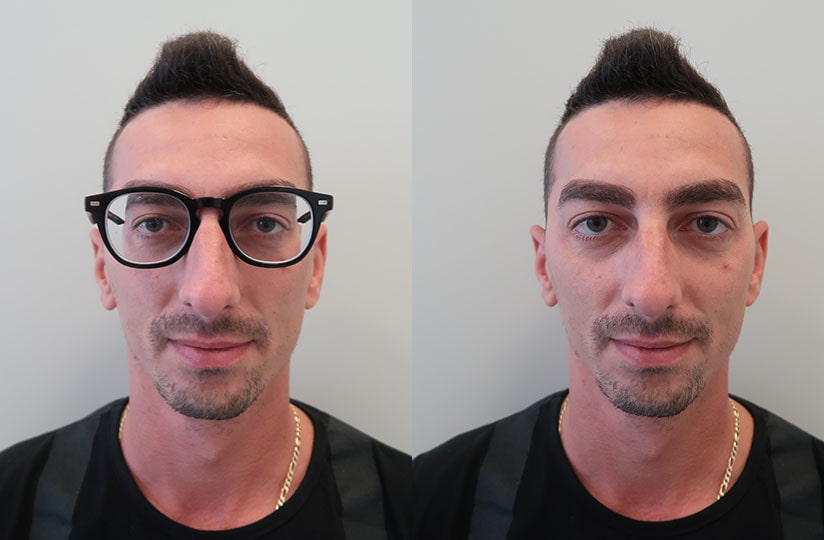 paziente con ambliopia intervento ReLEx SMILE